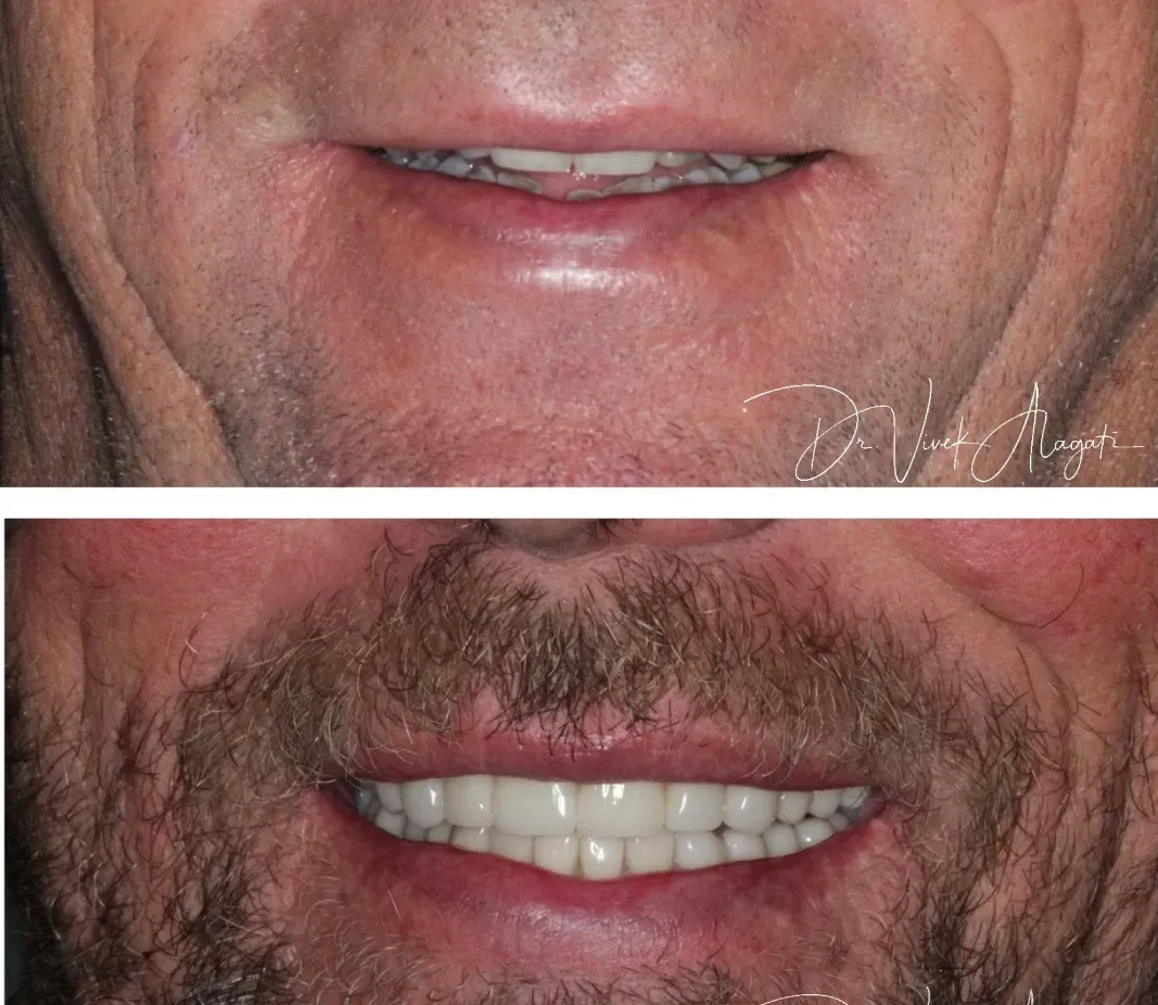 Two close-up lower-face photos: one clean-shaven, one with a mustache and beard.