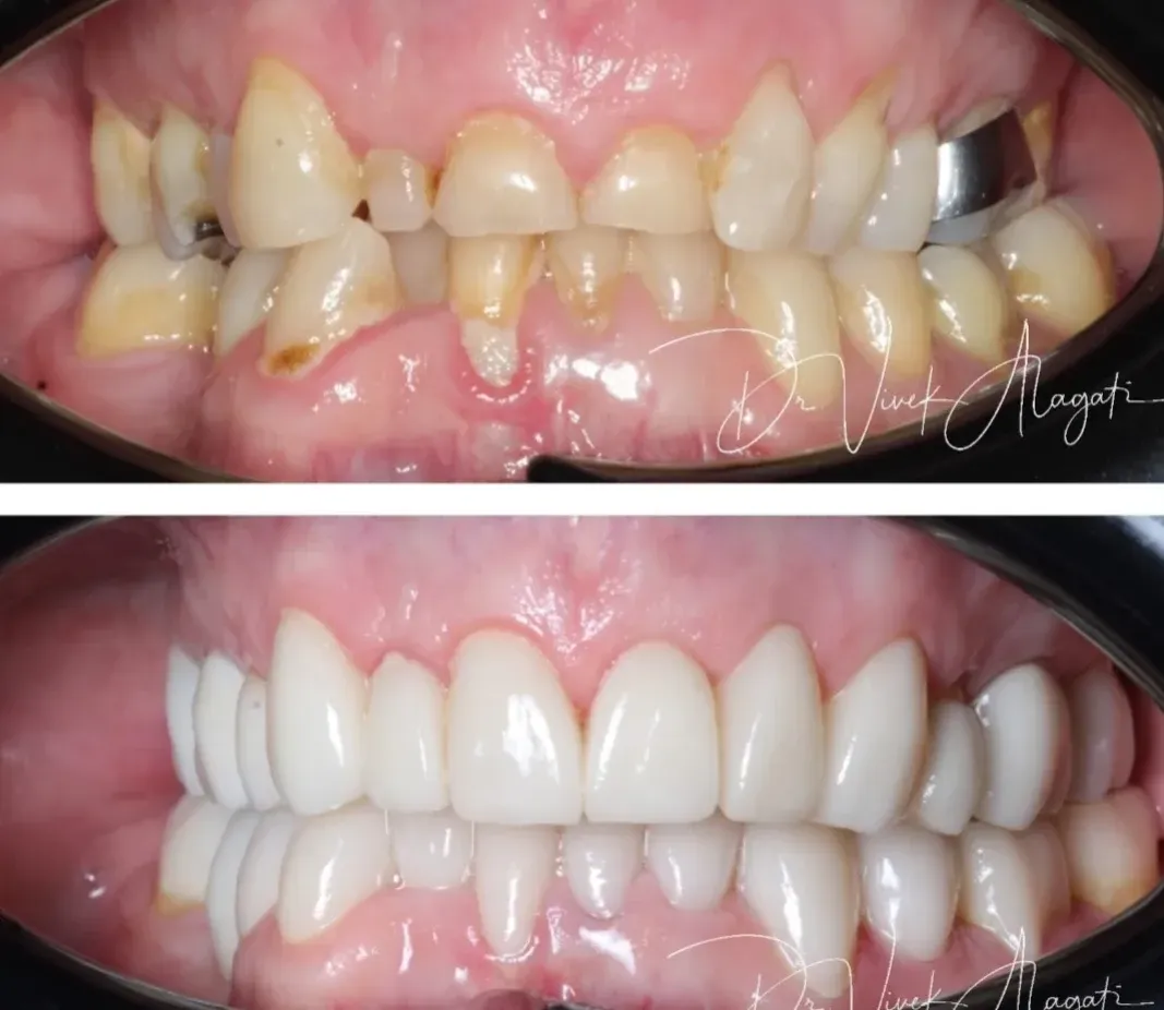 Before-and-after close-up of teeth: crooked, discolored teeth corrected to a bright, aligned smile