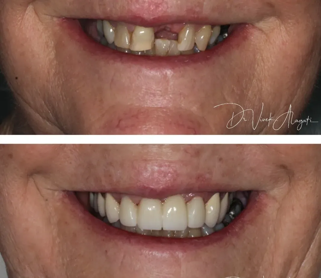 Before-and-after close-up of teeth: discolored, uneven smile above; whiter, straighter smile below.