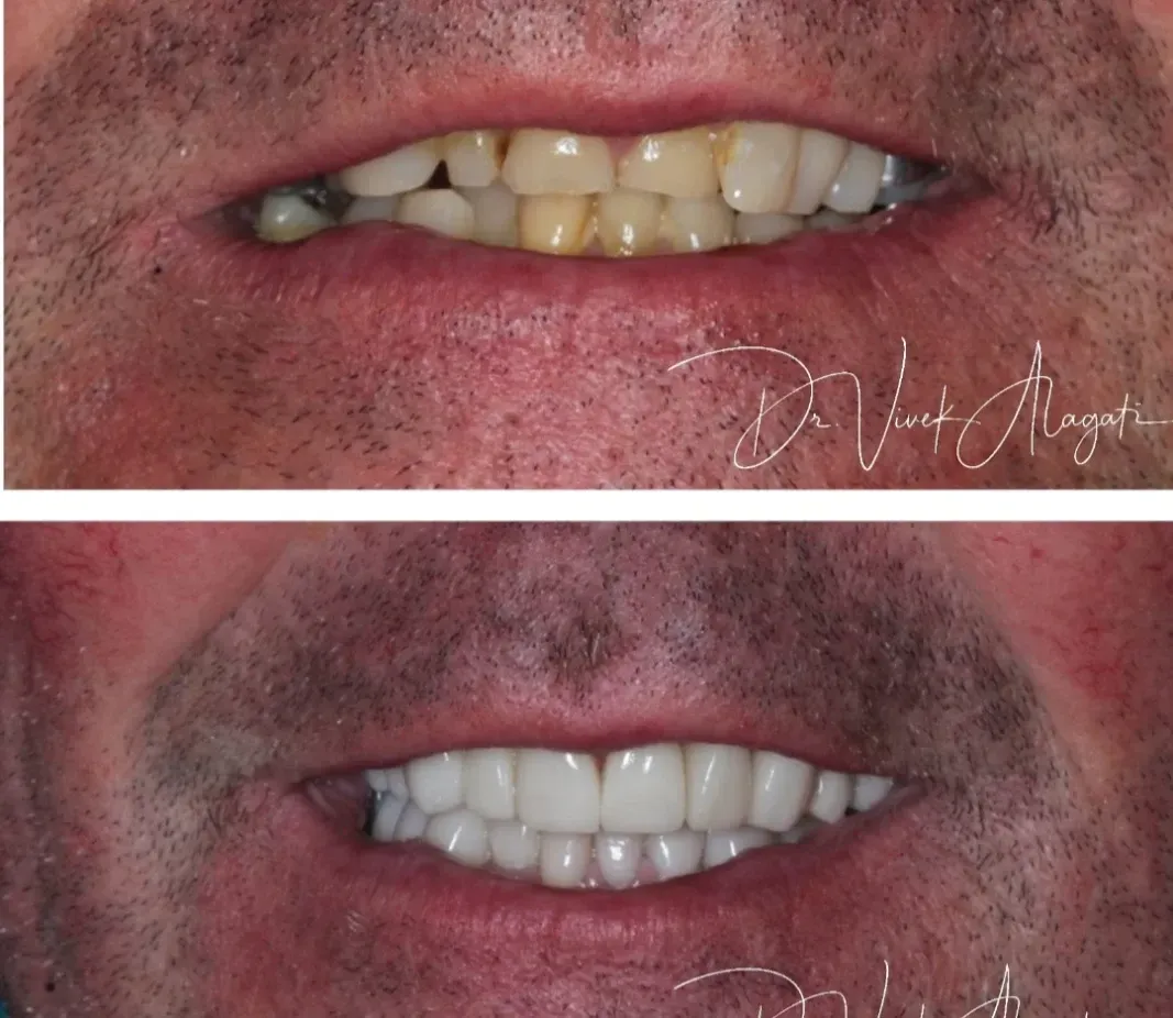 Before-and-after close-up of teeth, showing a yellowed smile above and whiter teeth below.