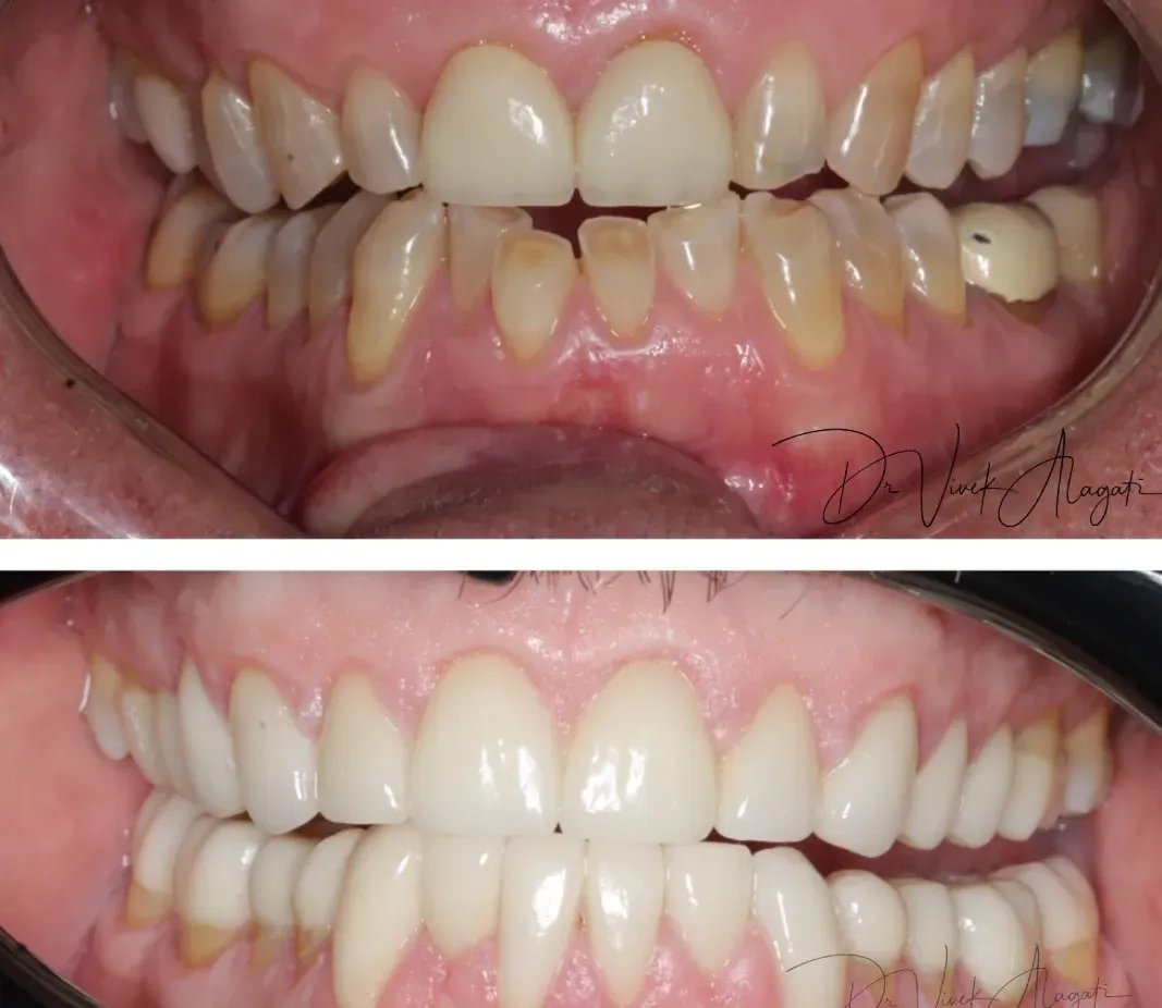 Before-and-after close-up of teeth, showing improved alignment and whitening in the lower and upper front teeth.