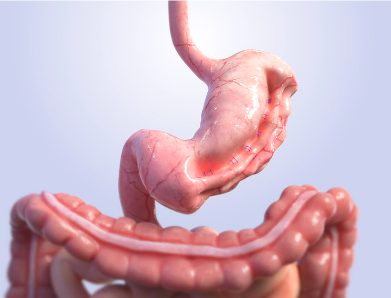 A close up of a person 's stomach and large intestine.