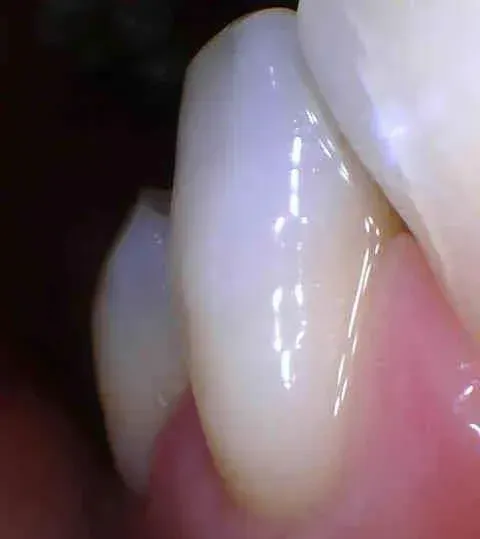 Close-up of a white tooth being cleaned with floss near pink gums