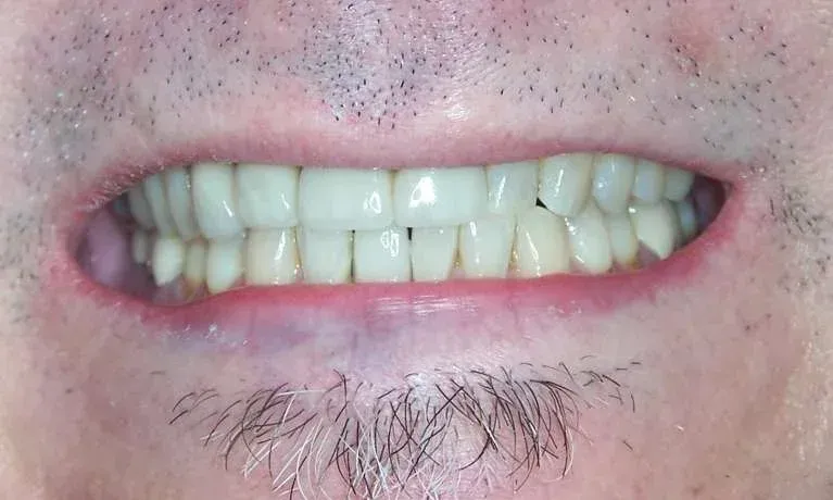 Close-up of a smiling mouth showing teeth with a small gap, and a mustache below the lip