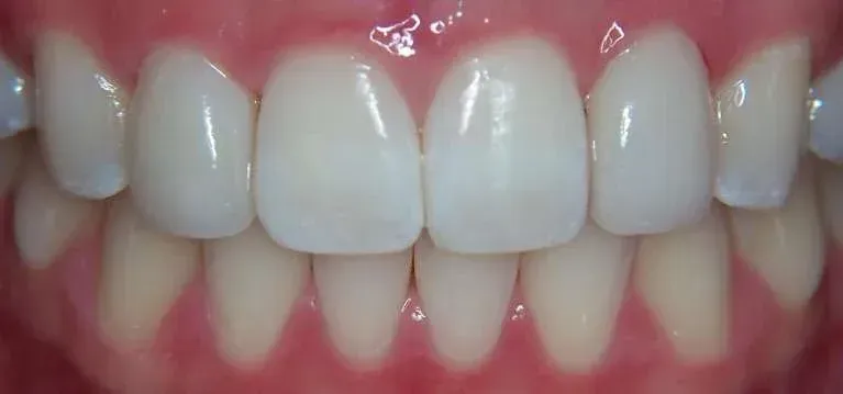 Close-up of a person’s front teeth and gums, showing a straight, white smile