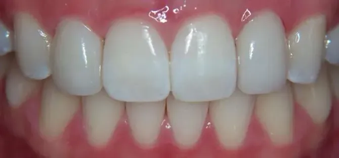 Close-up of a smiling mouth with white teeth and pink gums