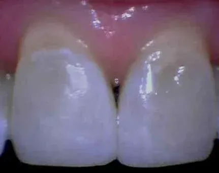 Close-up of two front teeth with a small gap between them and pink gums above