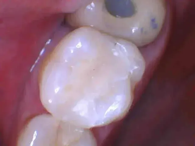 Close-up of a molar tooth with visible dental filling and surrounding gums