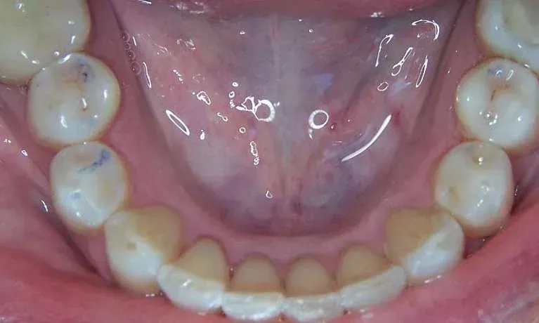 Close-up of the lower teeth and tongue inside a mouth, showing the inner arch and gums.