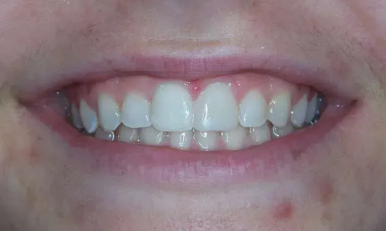 Close-up of a smiling mouth showing teeth and gums