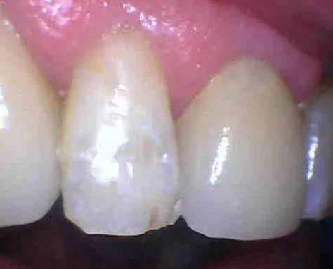 Close-up of front teeth, with one chipped white tooth beside pink gums