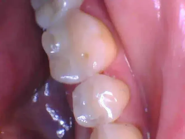 Close-up of teeth with a small cavity or decay spot on a molar.