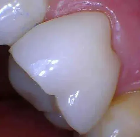 Close-up of a white tooth with a chipped corner next to pink gums