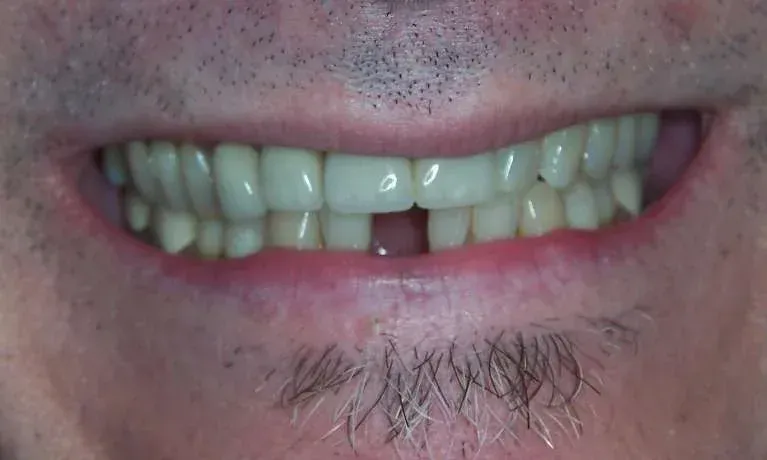 Close-up of a smiling mouth with visible teeth and a small mustache below the lip