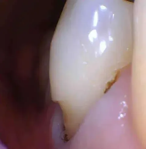 Close-up of a tooth with a small brown crack near the gumline