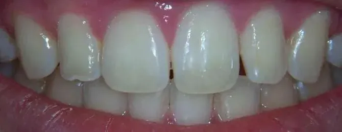 Close-up of a person’s teeth and smile with pink lips visible