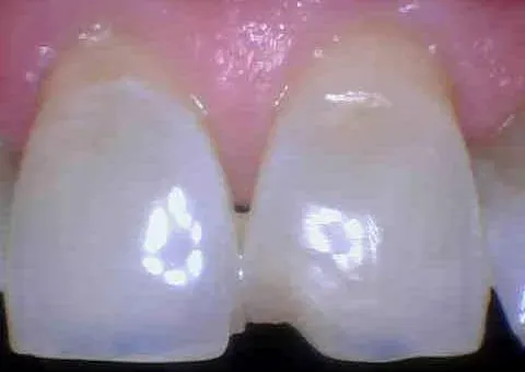 Close-up of two front teeth with a small gap between them and pink gums above