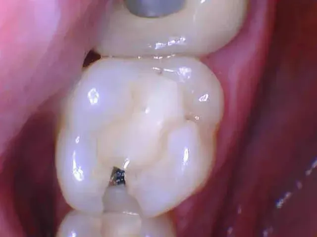 Close-up of a molar tooth with a small dark cavity near the chewing surface.