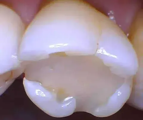 Close-up of a chipped front tooth with a missing section near the gumline