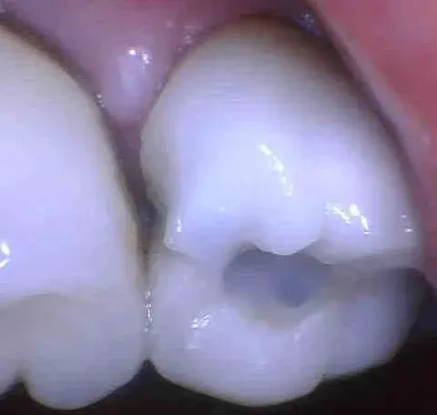 Close-up of two teeth with a dark cavity on a molar surface