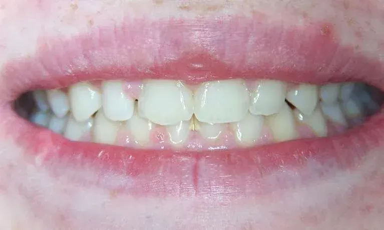 Close-up of a smiling mouth with visible teeth and pink lips