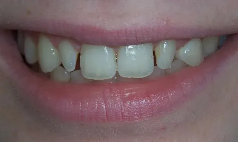 Close-up of a smiling mouth with visible front teeth and pink lips