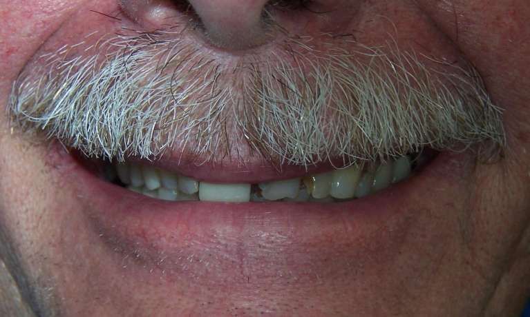3D illustration of teeth with a single white dental crown on a gum line