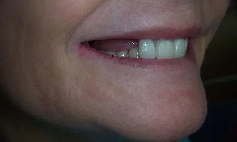 Close-up of a smiling mouth showing teeth and lips in profile