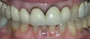 Close-up of a person's mouth with white teeth and pink gums, showing a gap between the upper front teeth