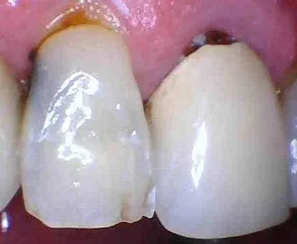 Close-up of two front teeth, one chipped with a visible brown stain near the gumline.