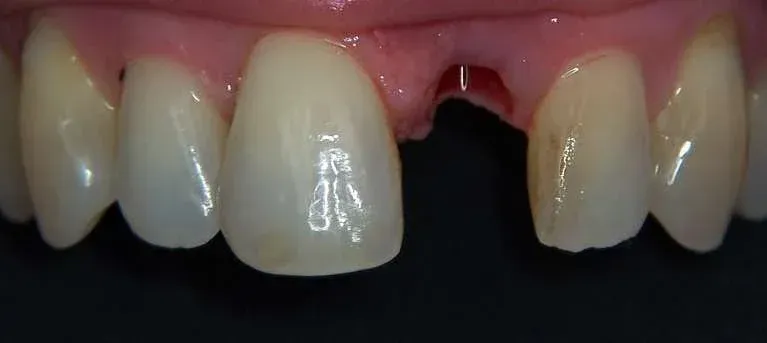 Close-up of upper teeth with a missing front tooth and two front teeth showing a gap