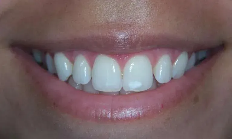Close-up of a smiling mouth showing white teeth and pink lips