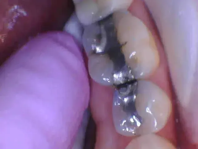 Close-up of molars with silver dental fillings in a mouth