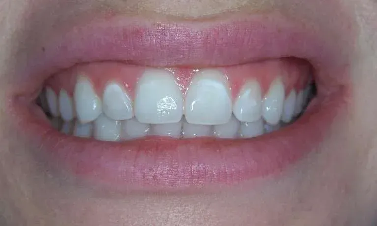Close-up of a smiling mouth with uneven teeth and a beard stubble around the chin and cheeks