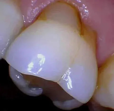 Close-up of a damaged tooth with a large brown cavity near the gumline
