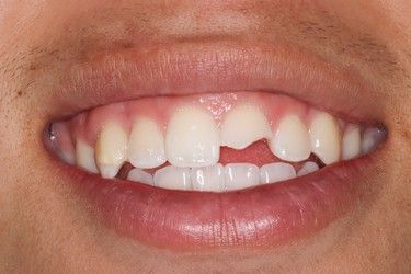 Close-up of a person's mouth, showing a chipped front tooth. The other teeth are white, and the gums are pink.