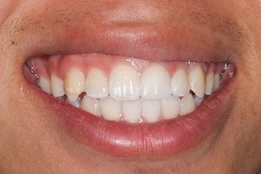 Close-up of a person smiling, showing a row of white teeth and pink gums. The lips are also pink.