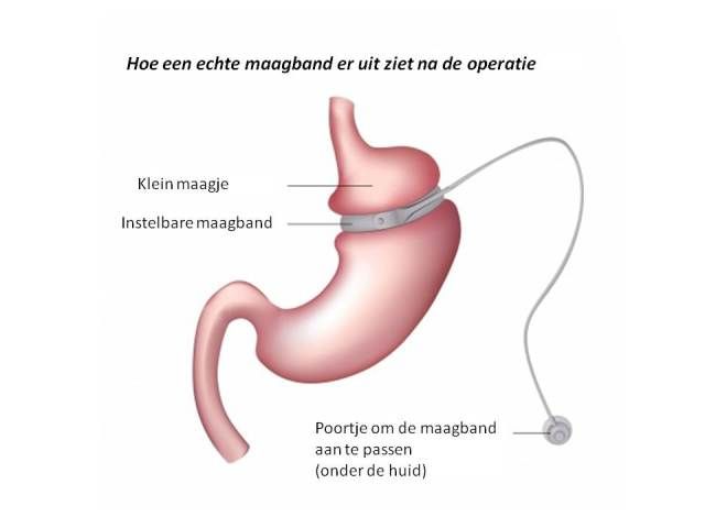 Een diagram van een maag met een band eromheen