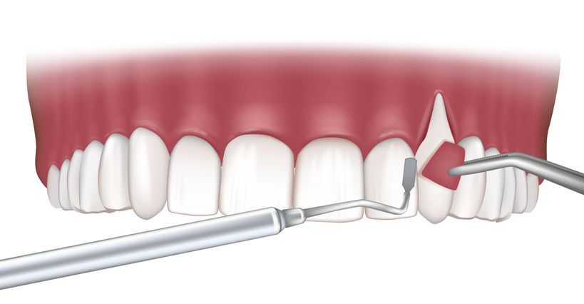 Periodontal Surgery