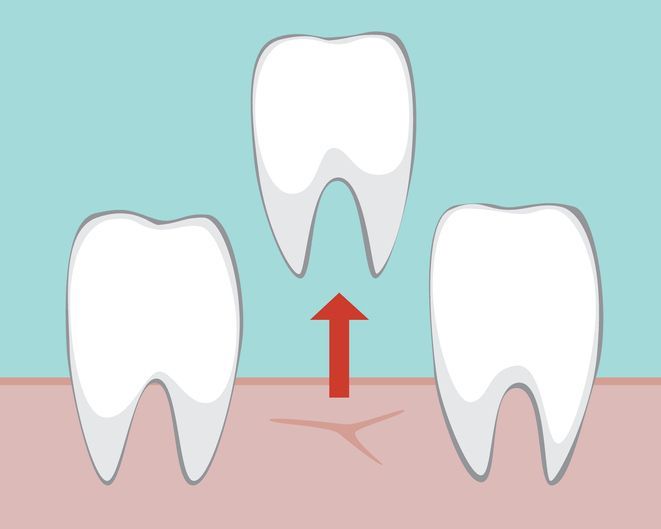 Tooth Extractions