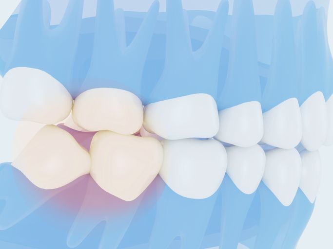 Wisdom Teeth Removal