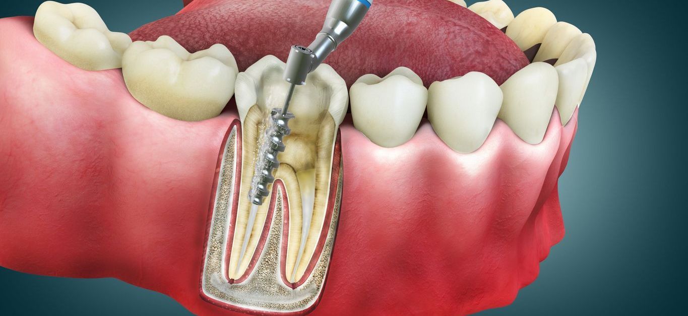 Root Canals