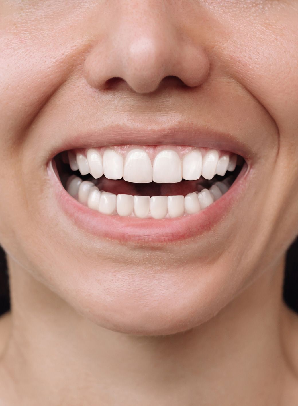 After Image of a Woman Smile with White Teeth — Mount Waverley, VIC — Mount Waverley Dental