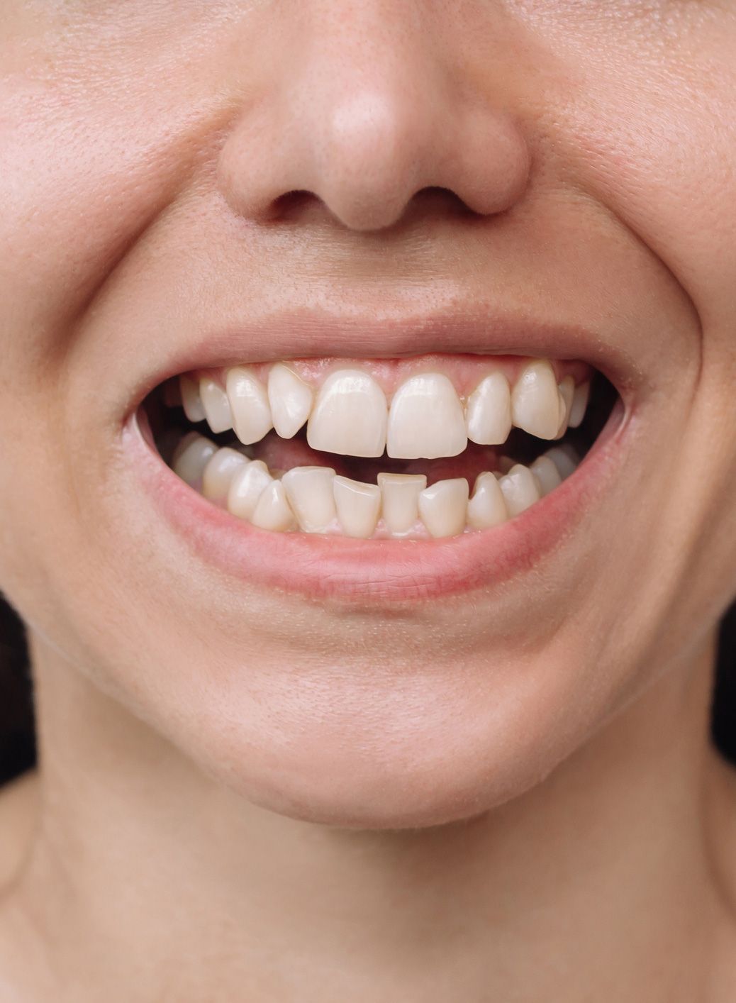 Before Image of a Woman's Mouth with a Missing Tooth — Mount Waverley, VIC — Mount Waverley Dental