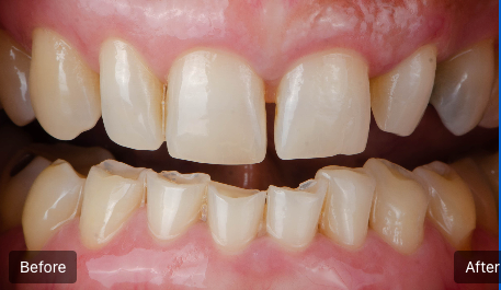 Close-up of teeth before and after whitening, showing brighter upper and lower teeth.