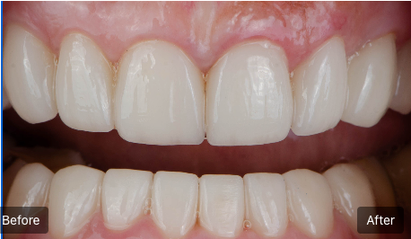 Before-and-after close-up of brightened front teeth and gums, showing a whitening comparison.