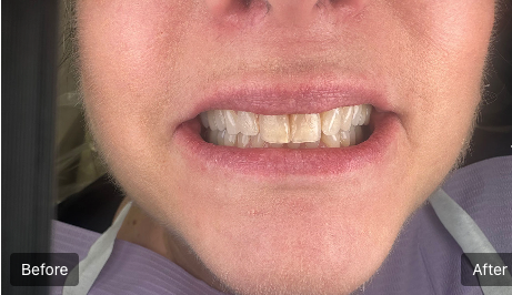 Close-up of teeth with a before-and-after comparison, showing improved whitening on the right side.