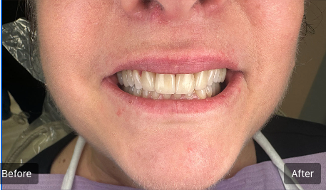 Close-up of a person's mouth showing teeth, labeled
