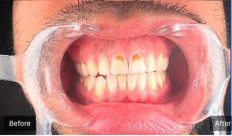 Close-up of teeth with before-and-after braces comparison and mouth retractor exposed.