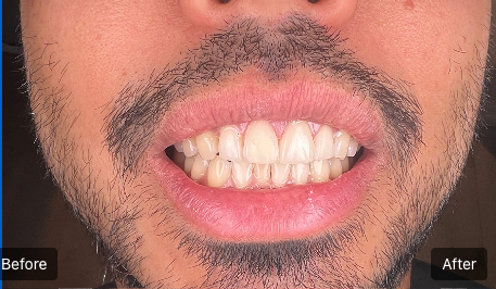 Before-and-after close-up of a smiling mouth, showing whitening results on teeth.